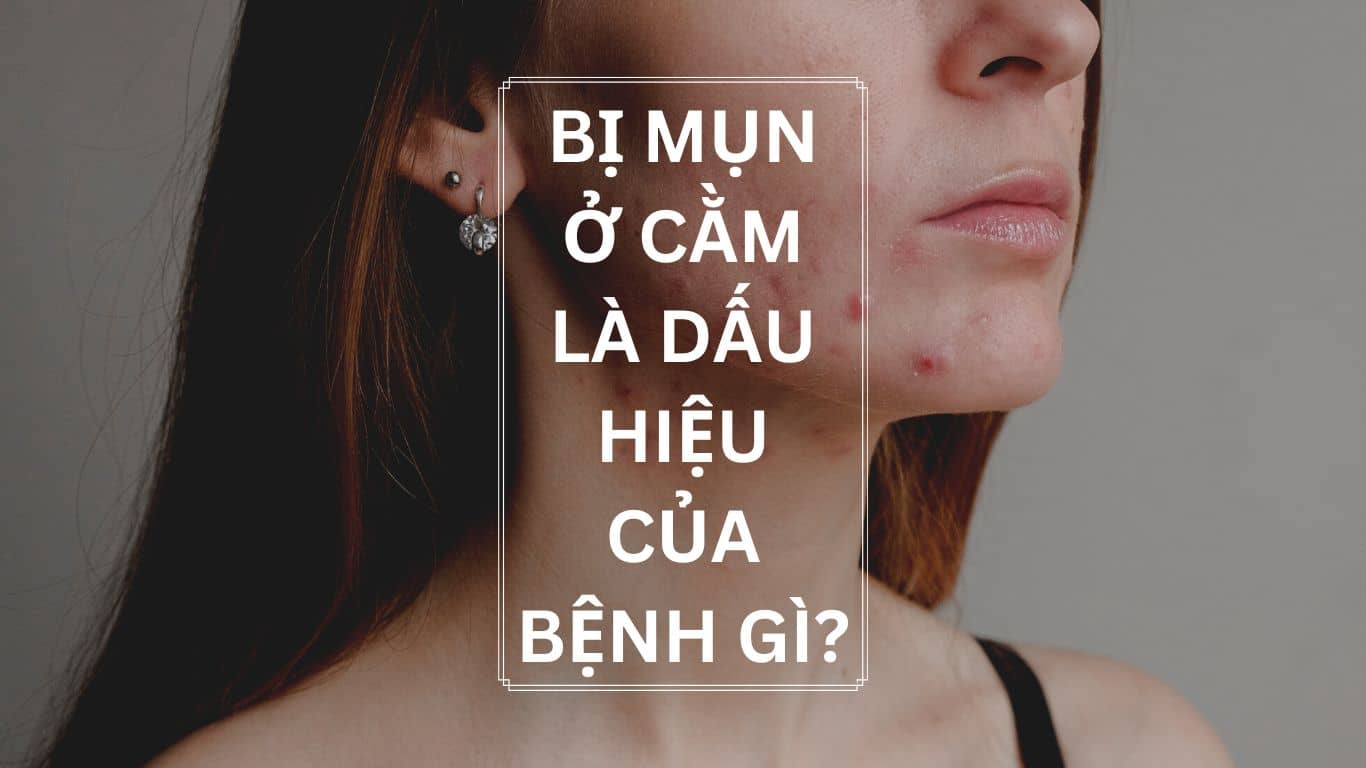 Bị mụn ở cằm là dấu hiệu của bệnh gì? Nguyên nhân và cách điều trị hiệu quả